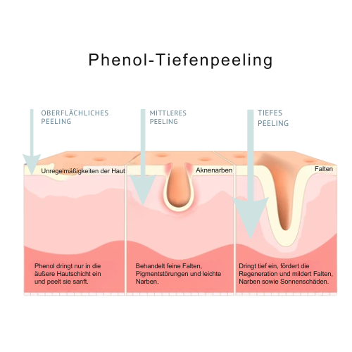 Phenol Peeling Schema
