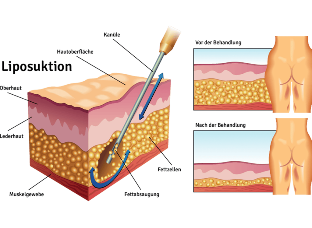 Liposuktion