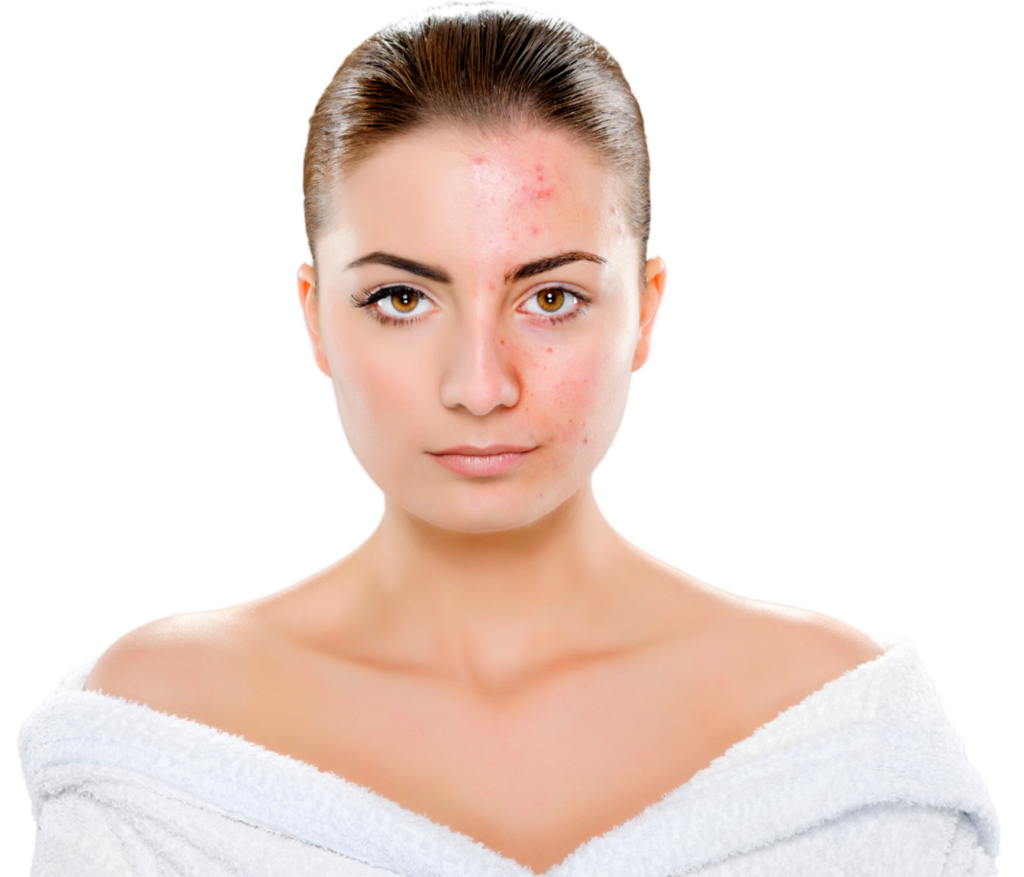 Phenol Peeling